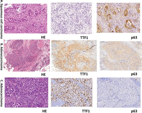 lung cancer biopsy results negative|Radiological.